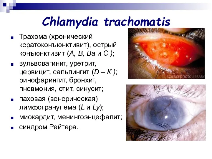 Chlamydia trachomatis Трахома (хронический кератоконъюнктивит), острый конъюнктивит (А, В, Ва и