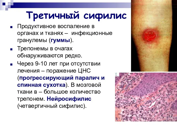 Третичный сифилис Продуктивное воспаление в органах и тканях – инфекционные гранулемы
