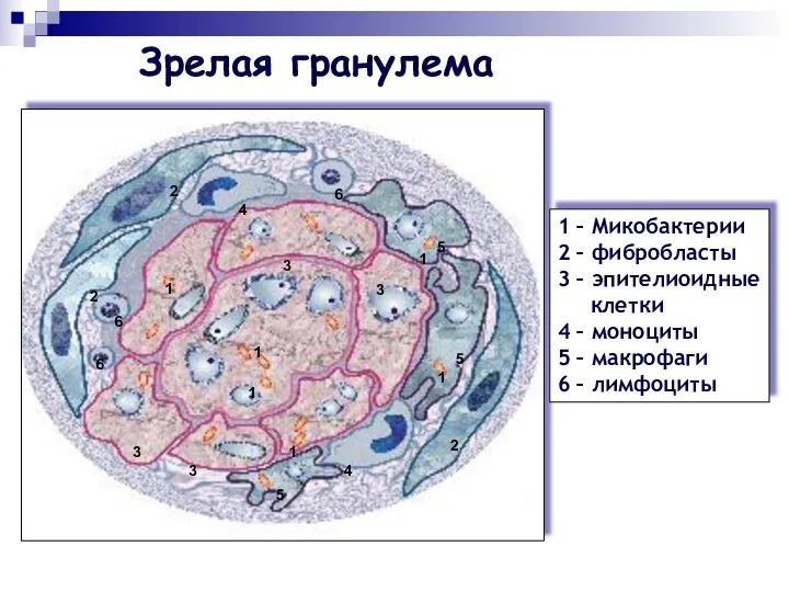 Зрелая гранулема 1 – Микобактерии 2 – фибробласты 3 – эпителиоидные