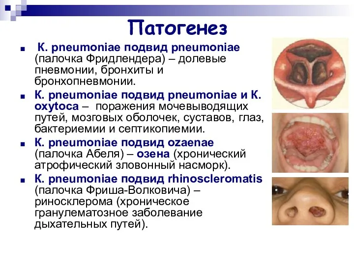 Патогенез К. pneumoniae подвид pneumoniae (палочка Фридлендера) – долевые пневмонии, бронхиты