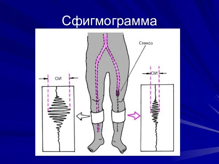 Сфигмограмма