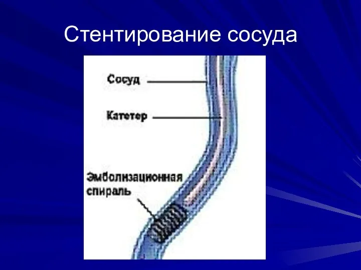 Стентирование сосуда