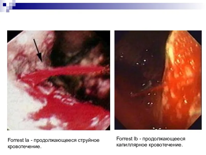 Forrest la - продолжающееся струйное кровотечение. Forrest lb - продолжающееся капиллярное кровотечение.