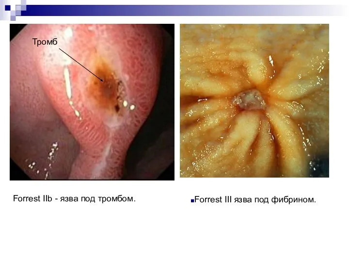 Forrest III язва под фибрином. Тромб Forrest IIb - язва под тромбом.