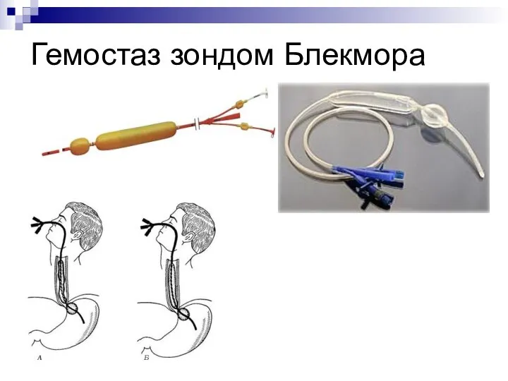 Гемостаз зондом Блекмора