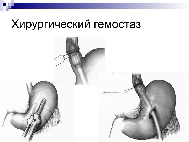 Хирургический гемостаз