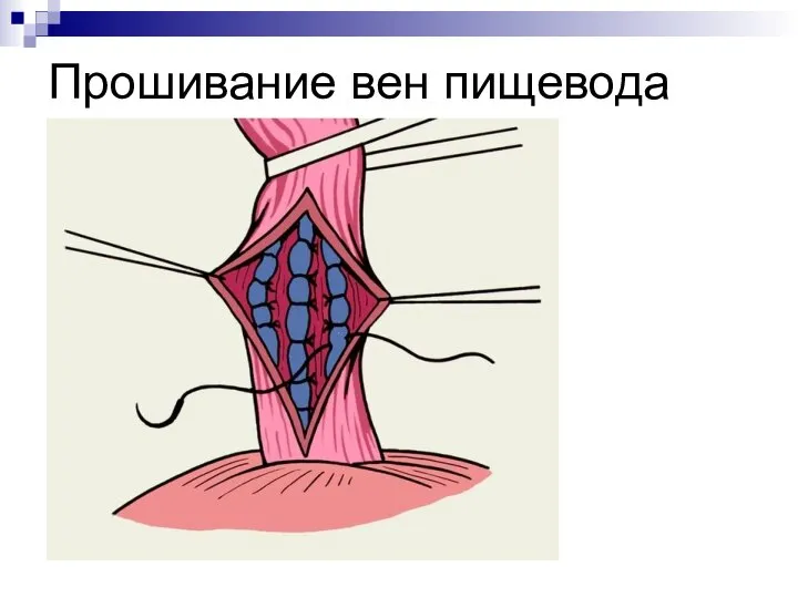 Прошивание вен пищевода