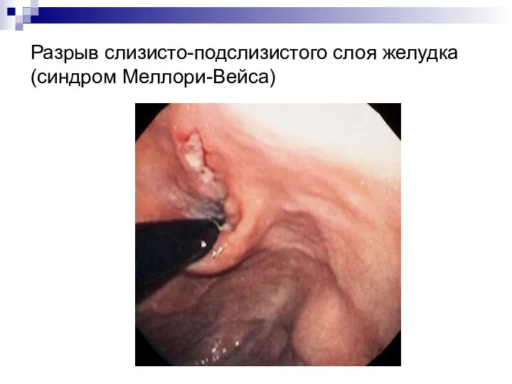 Разрыв слизисто-подслизистого слоя желудка (синдром Меллори-Вейса)