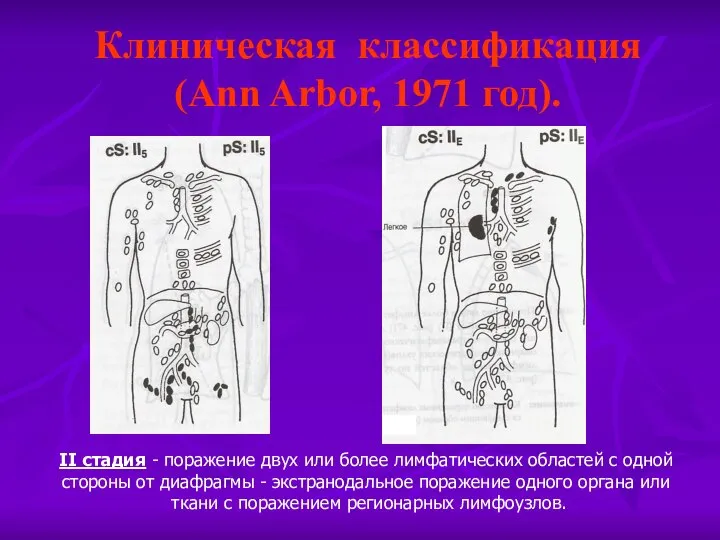 Клиническая классификация (Ann Arbor, 1971 год). II стадия - поражение двух