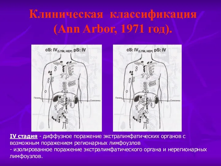 Клиническая классификация (Ann Arbor, 1971 год). IV стадия - диффузное поражение