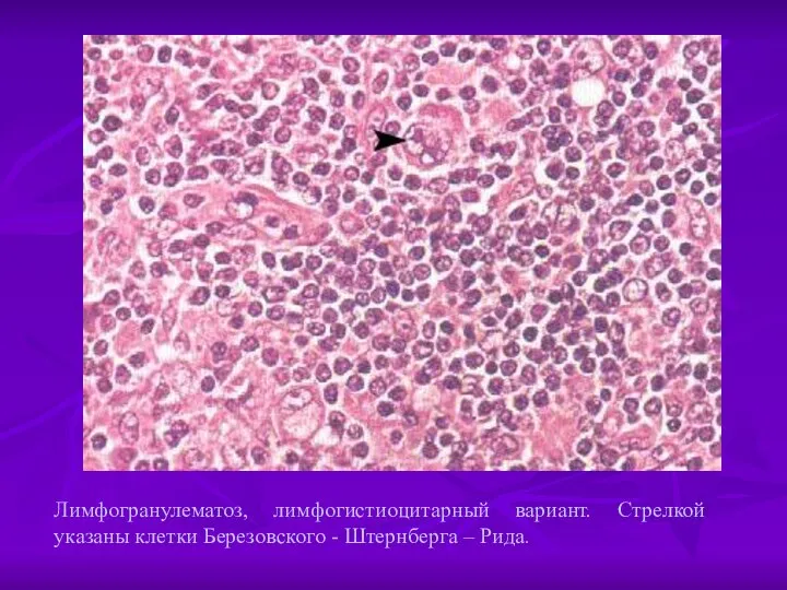 Лимфогранулематоз, лимфогистиоцитарный вариант. Стрелкой указаны клетки Березовского - Штернберга – Рида.