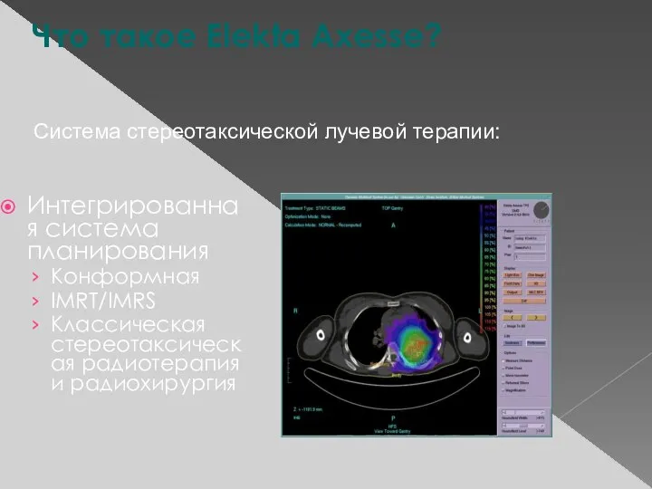 Интегрированная система планирования Конформная IMRT/IMRS Классическая стереотаксическая радиотерапия и радиохирургия Что