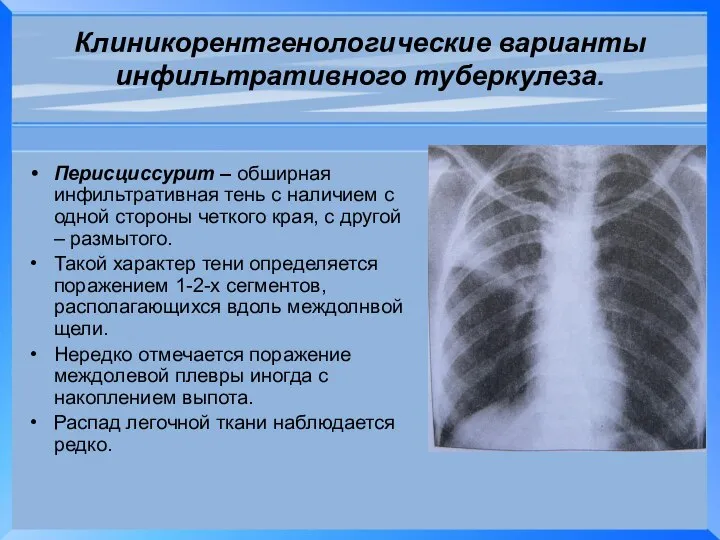 Клиникорентгенологические варианты инфильтративного туберкулеза. Перисциссурит – обширная инфильтративная тень с наличием