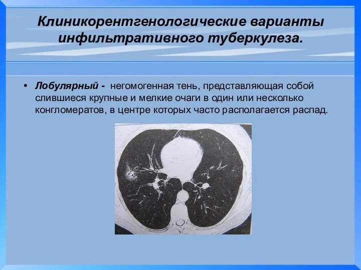 Клиникорентгенологические варианты инфильтративного туберкулеза. Лобулярный - негомогенная тень, представляющая собой слившиеся