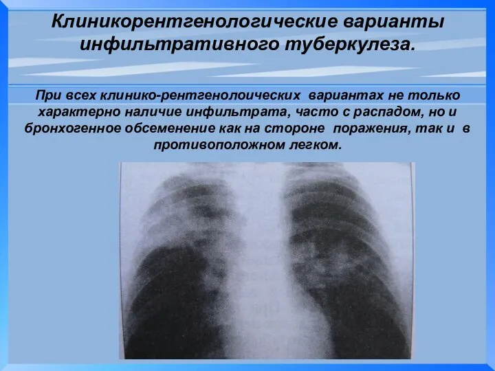 Клиникорентгенологические варианты инфильтративного туберкулеза. При всех клинико-рентгенолоических вариантах не только характерно