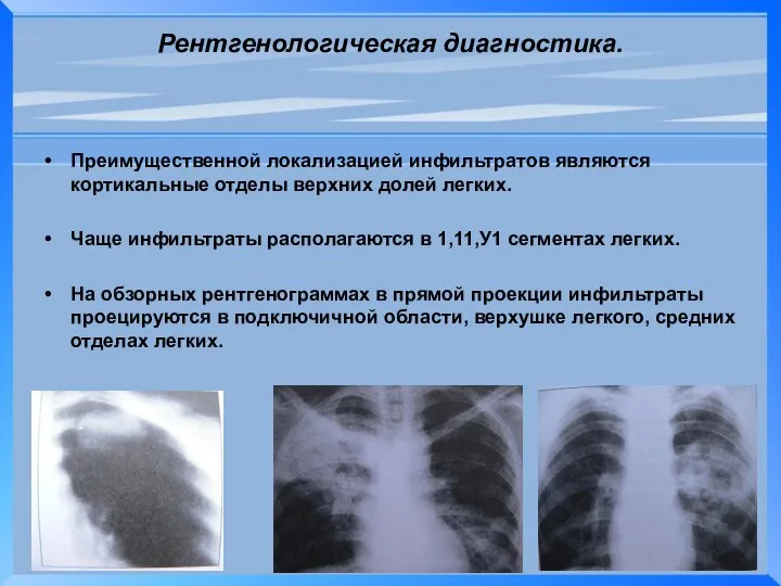 Рентгенологическая диагностика. Преимущественной локализацией инфильтратов являются кортикальные отделы верхних долей легких.
