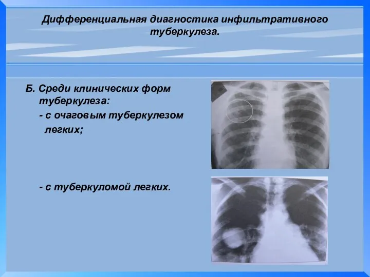 Дифференциальная диагностика инфильтративного туберкулеза. Б. Среди клинических форм туберкулеза: - с