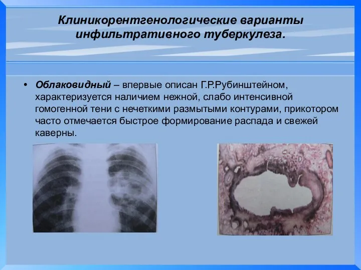 Клиникорентгенологические варианты инфильтративного туберкулеза. Облаковидный – впервые описан Г.Р.Рубинштейном, характеризуется наличием