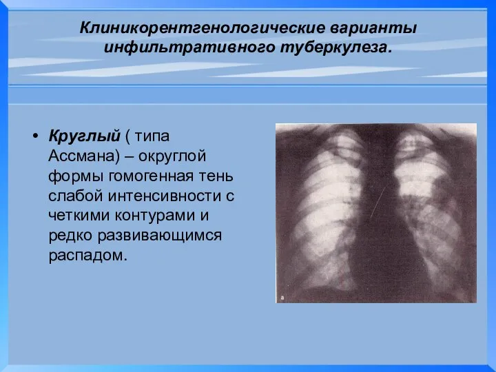 Клиникорентгенологические варианты инфильтративного туберкулеза. Круглый ( типа Ассмана) – округлой формы
