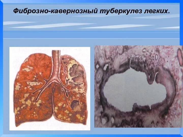 Фиброзно-кавернозный туберкулез легких.