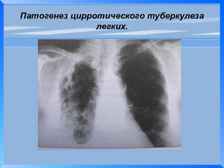 Патогенез цирротического туберкулеза легких.
