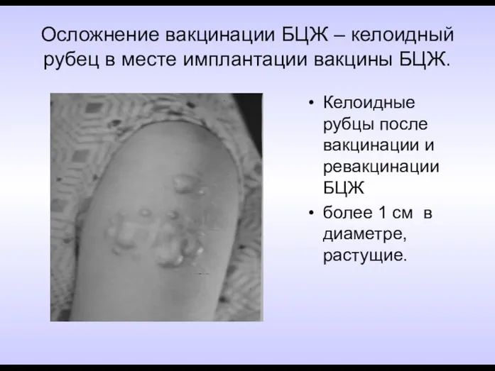 Осложнение вакцинации БЦЖ – келоидный рубец в месте имплантации вакцины БЦЖ.