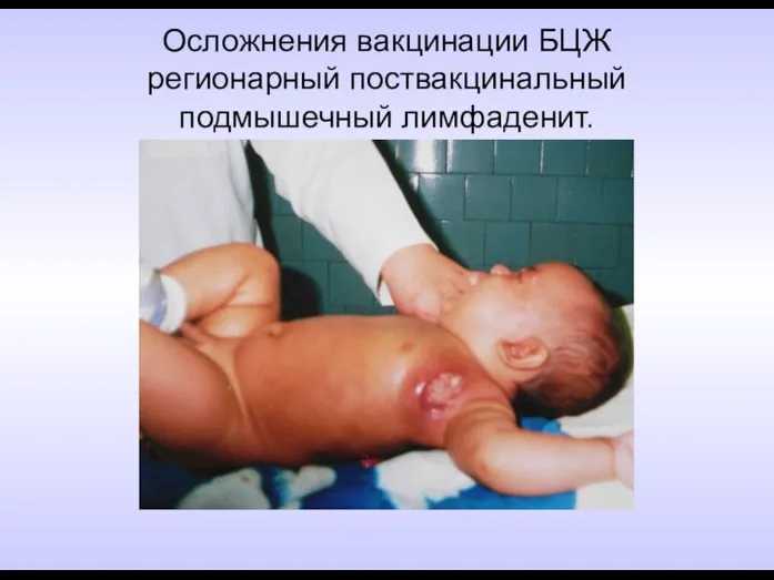 Осложнения вакцинации БЦЖ регионарный поствакцинальный подмышечный лимфаденит.