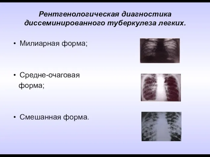 Рентгенологическая диагностика диссеминированного туберкулеза легких. Милиарная форма; Средне-очаговая форма; Смешанная форма.