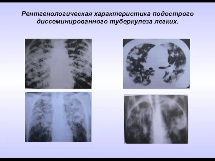 Рентгенологическая характеристика подострого диссеминированного туберкулеза легких.