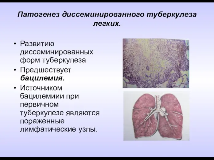 Патогенез диссеминированного туберкулеза легких. Развитию диссеминированных форм туберкулеза Предшествует бацилемия. Источником