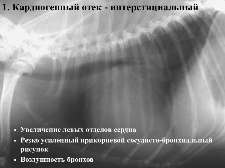 1. Кардиогенный отек - интерстициальный Увеличение левых отделов сердца Резко усиленный прикорневой сосудисто-бронхиальный рисунок Воздушность бронхов