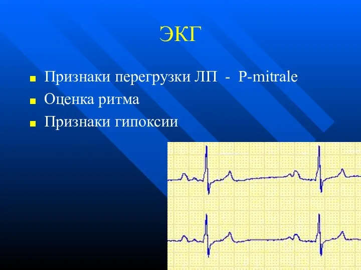 ЭКГ Признаки перегрузки ЛП - Р-mitrale Оценка ритма Признаки гипоксии