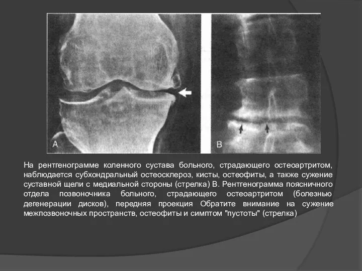 На рентгенограмме коленного сустава больного, страдающего остеоартритом, наблюдается субхондральный остеосклероз, кисты,