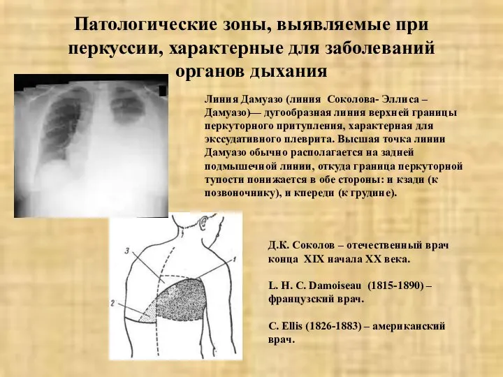 Патологические зоны, выявляемые при перкуссии, характерные для заболеваний органов дыхания Линия