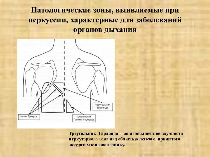 Патологические зоны, выявляемые при перкуссии, характерные для заболеваний органов дыхания Треугольник