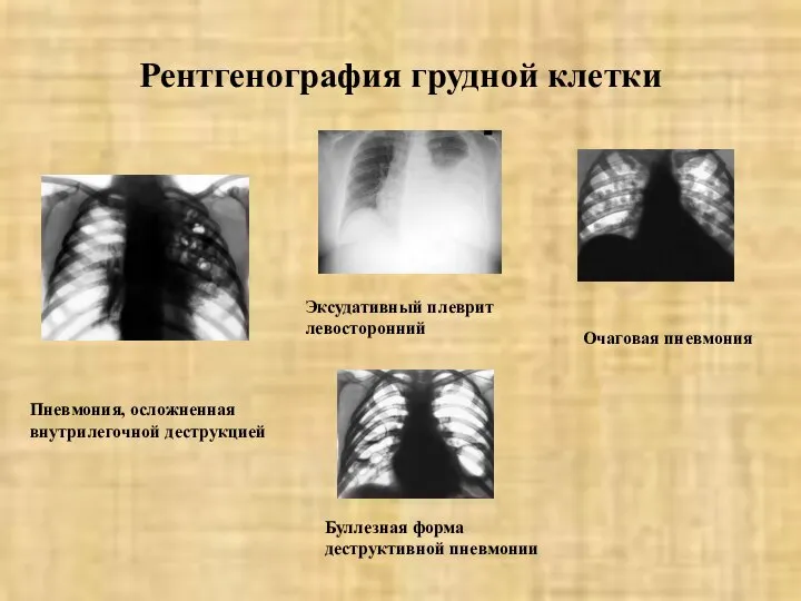 Рентгенография грудной клетки Пневмония, осложненная внутрилегочной деструкцией Эксудативный плеврит левосторонний Очаговая пневмония Буллезная форма деструктивной пневмонии