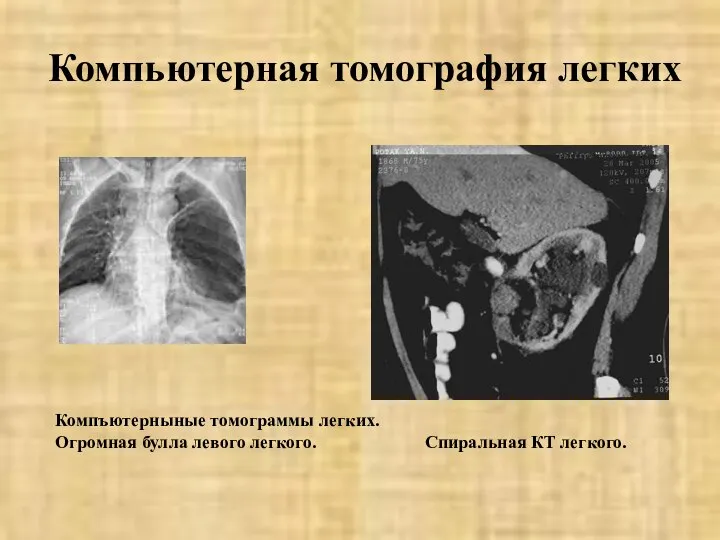 Компьютерная томография легких Компъютерныные томограммы легких. Огромная булла левого легкого. Спиральная КТ легкого.