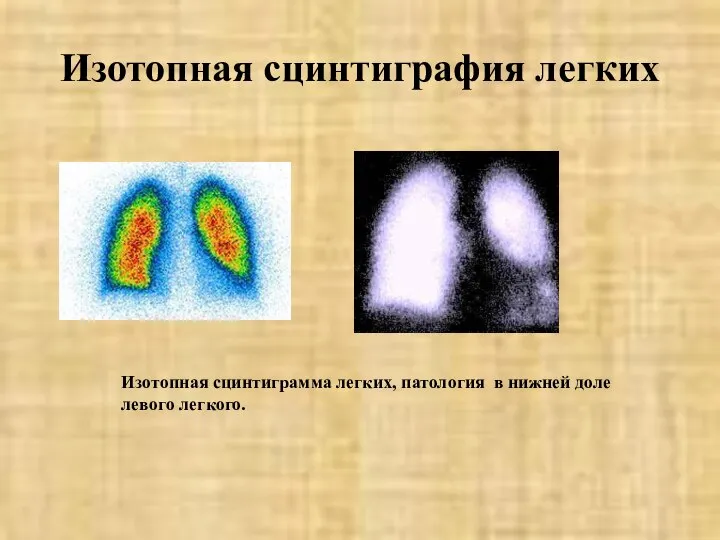 Изотопная сцинтиграфия легких Изотопная сцинтиграмма легких, патология в нижней доле левого легкого.