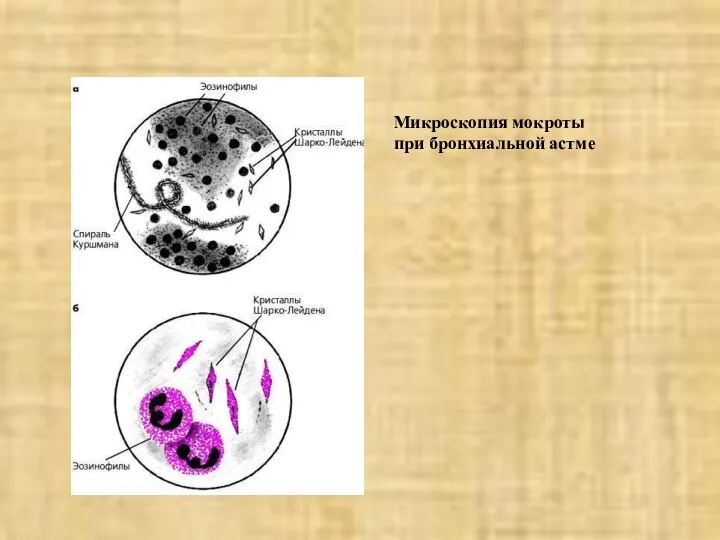 Микроскопия мокроты при бронхиальной астме