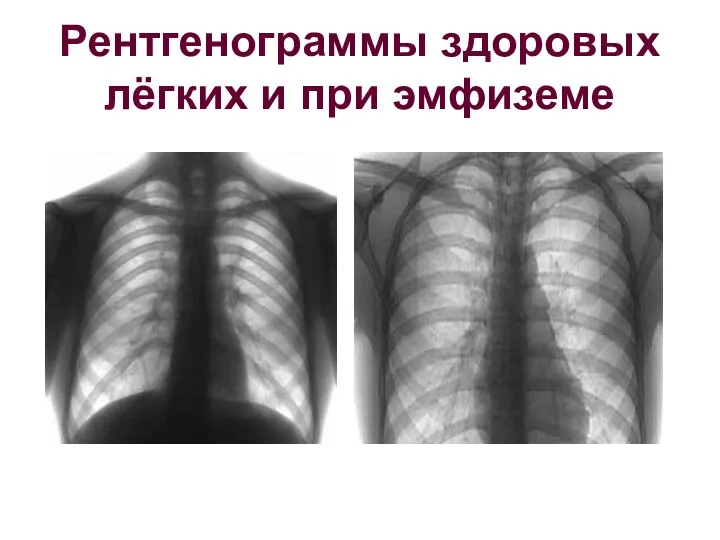 Рентгенограммы здоровых лёгких и при эмфиземе