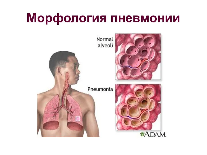Морфология пневмонии