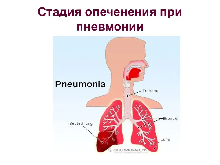 Стадия опеченения при пневмонии