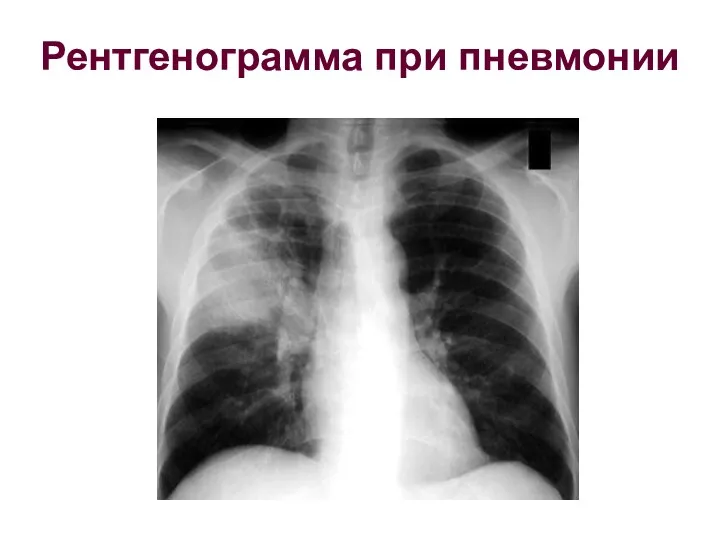 Рентгенограмма при пневмонии