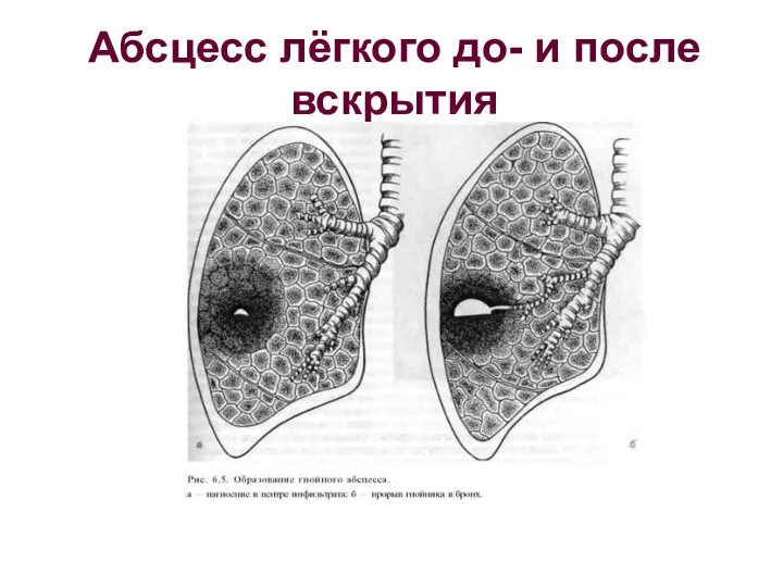 Абсцесс лёгкого до- и после вскрытия