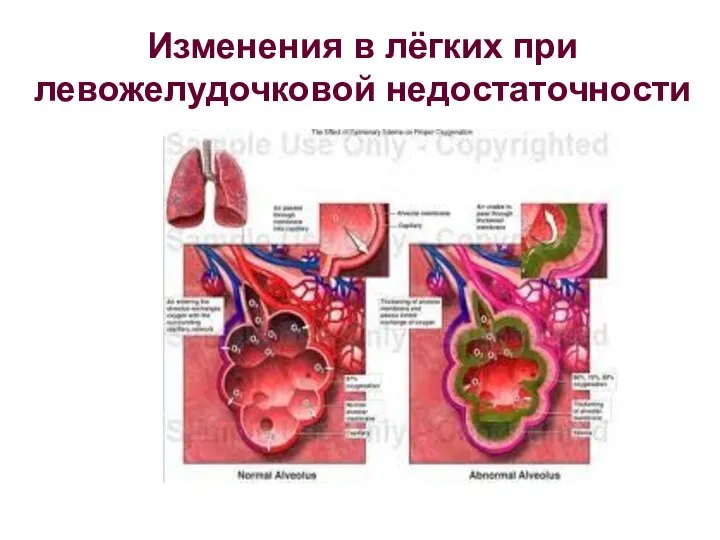 Изменения в лёгких при левожелудочковой недостаточности