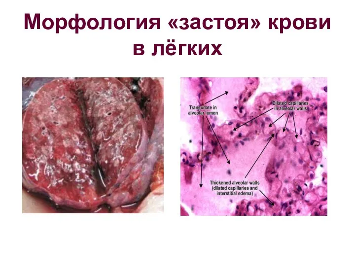 Морфология «застоя» крови в лёгких