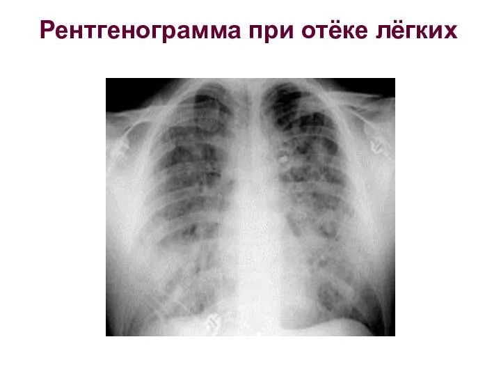Рентгенограмма при отёке лёгких