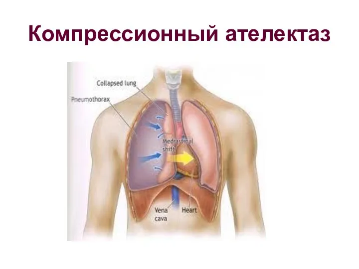 Компрессионный ателектаз