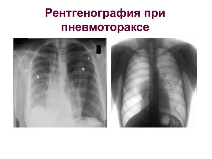Рентгенография при пневмотораксе