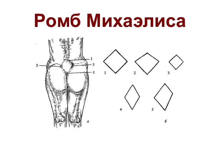 Ромб Михаэлиса